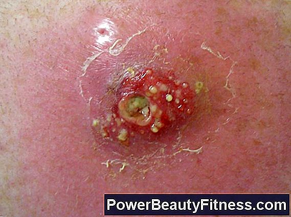 remedies for scalp folliculitis all about fitness and healthy
