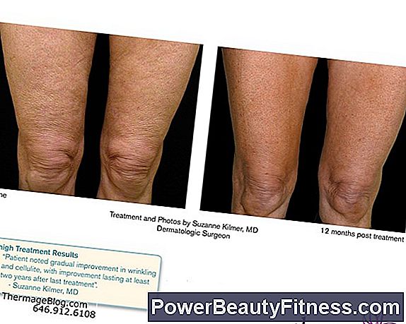 Come Rimuovere un Pelo Incarnito: 10 Passaggi Che cosa e la zona di rimozione dei capelli laser bikini profondo
