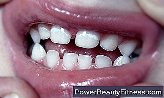 abcesul dinților provoacă pierderea în greutate)
