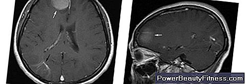 Brain Tumor In The Occipital Lobe