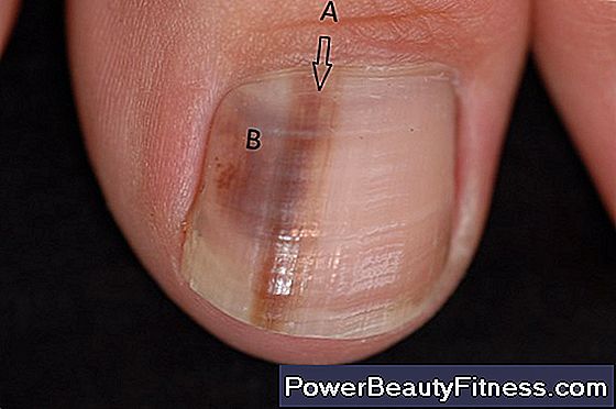 Causes Of Black Spots On The Toenails