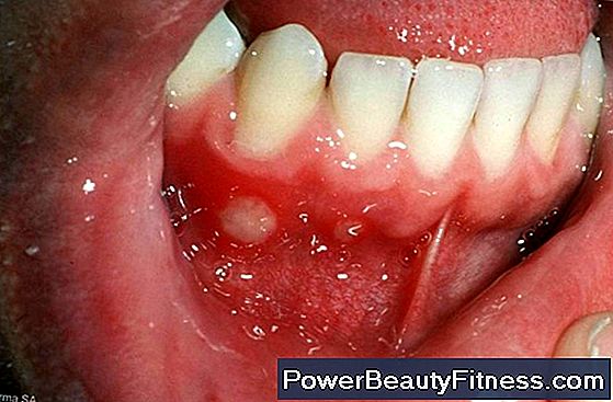 How To Get Rid Of A Canker Sore On A Child'S Gums?