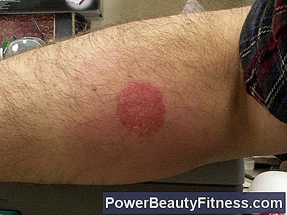 How To Identify Insect Bites With Bruises 💪 All About Fitness And