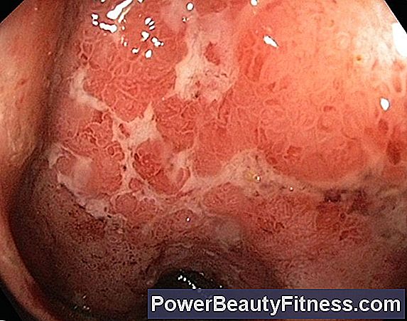 Treatment Of Colon Ulcer