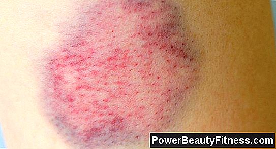 What Causes Bruises To Form On Your Skin When You Tap Lightly?