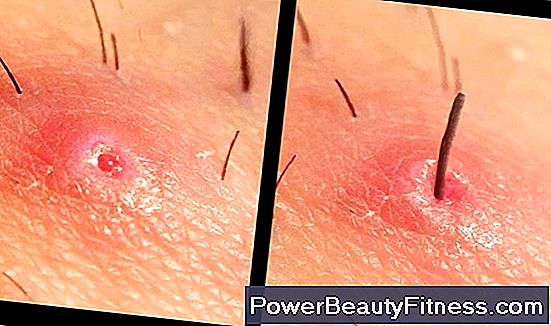 Brazilian Wax Ingrown Hairs