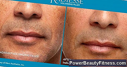 Wrinkles On The Lips And Juvederm