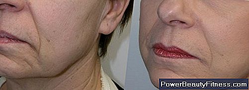 How To Firm Up The Skin Under The Chin After Weight Loss