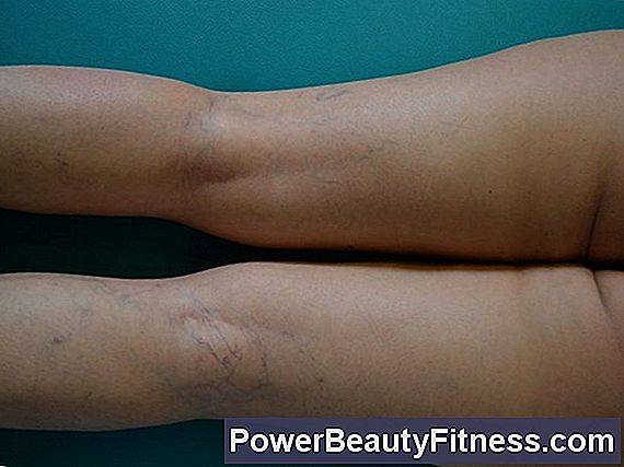 Piccole Macchie Rosse Sulle Gambe Dopo L Esercizio Tutto Su Fitness E Stile Di Vita Sano 2023